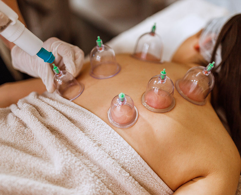 کاربردهای Cupping در فیزیوتراپی