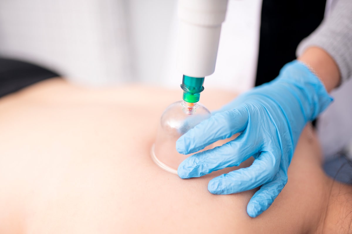 Cupping Therapy در فیزیوتراپی