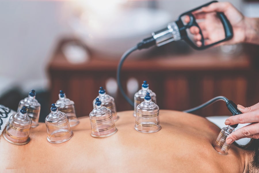 Cupping
