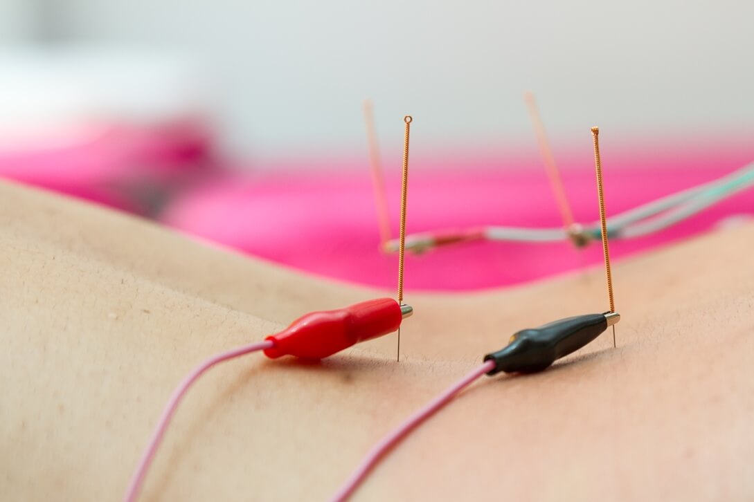 Electroacupuncture
