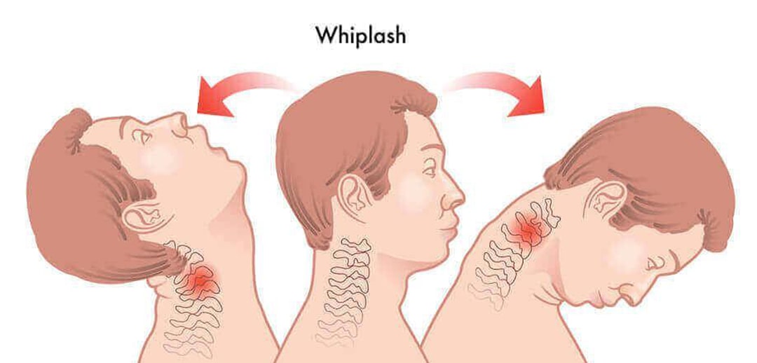 درمان آسیب Whiplash در کلینیک فیزیوتراپی